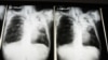 Tuberculose mata em Malanje
