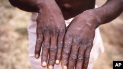 Monkeypox Africa